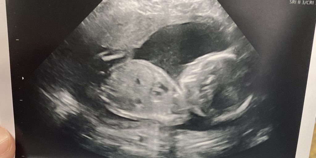 Babys heart in ultrasound photo